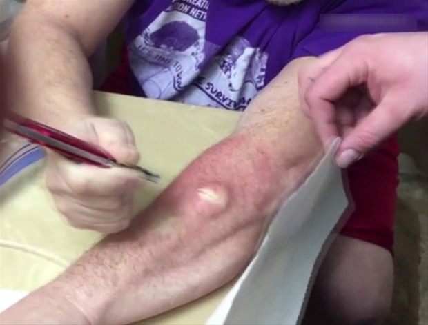 Kolundaki kisti kendi çıkardı 10