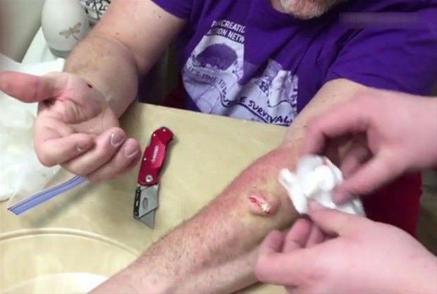 Kolundaki kisti kendi çıkardı 14