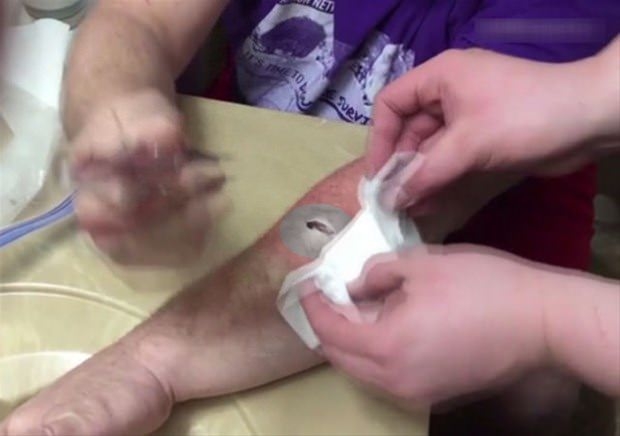 Kolundaki kisti kendi çıkardı 16