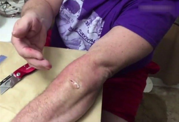 Kolundaki kisti kendi çıkardı 2