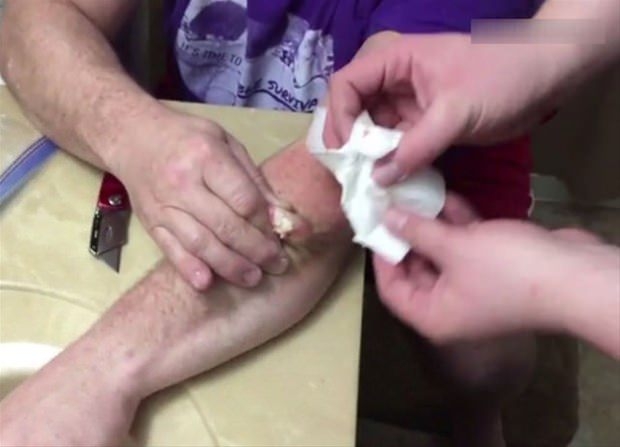 Kolundaki kisti kendi çıkardı 20