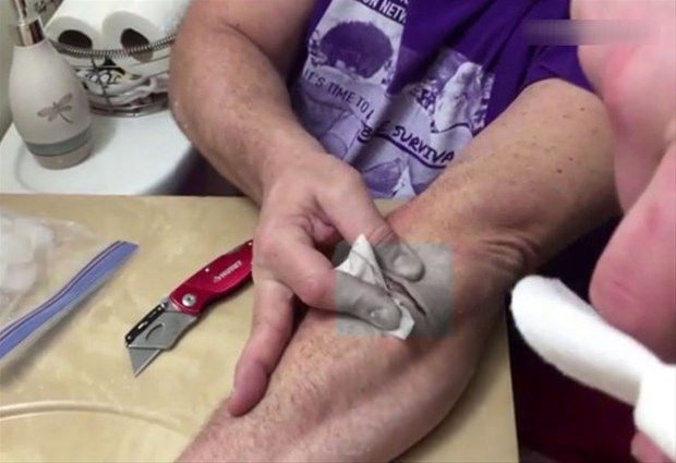 Kolundaki kisti kendi çıkardı 22