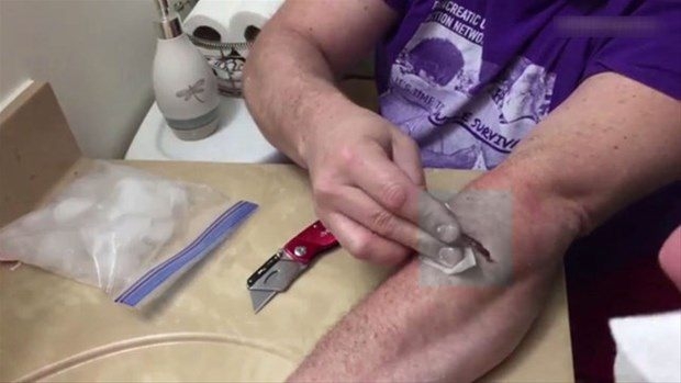 Kolundaki kisti kendi çıkardı 23