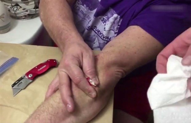 Kolundaki kisti kendi çıkardı 24