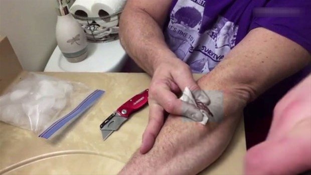 Kolundaki kisti kendi çıkardı 26