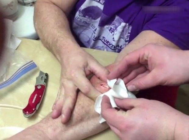 Kolundaki kisti kendi çıkardı 5