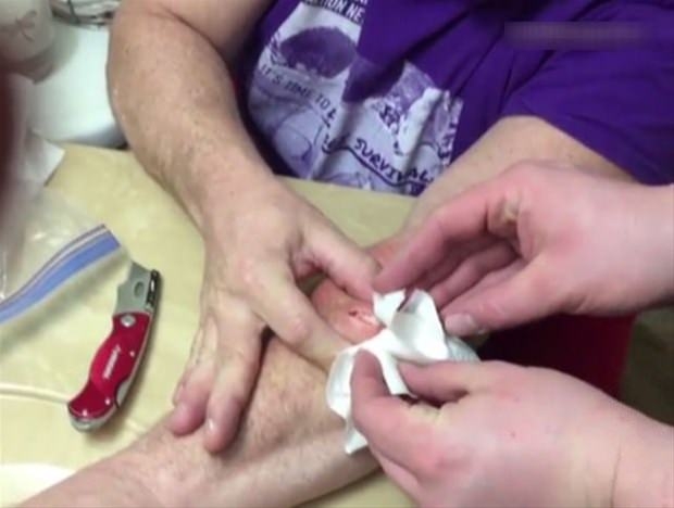 Kolundaki kisti kendi çıkardı 7