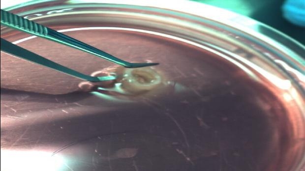 Türk doktorlar bir ilki başardı 4