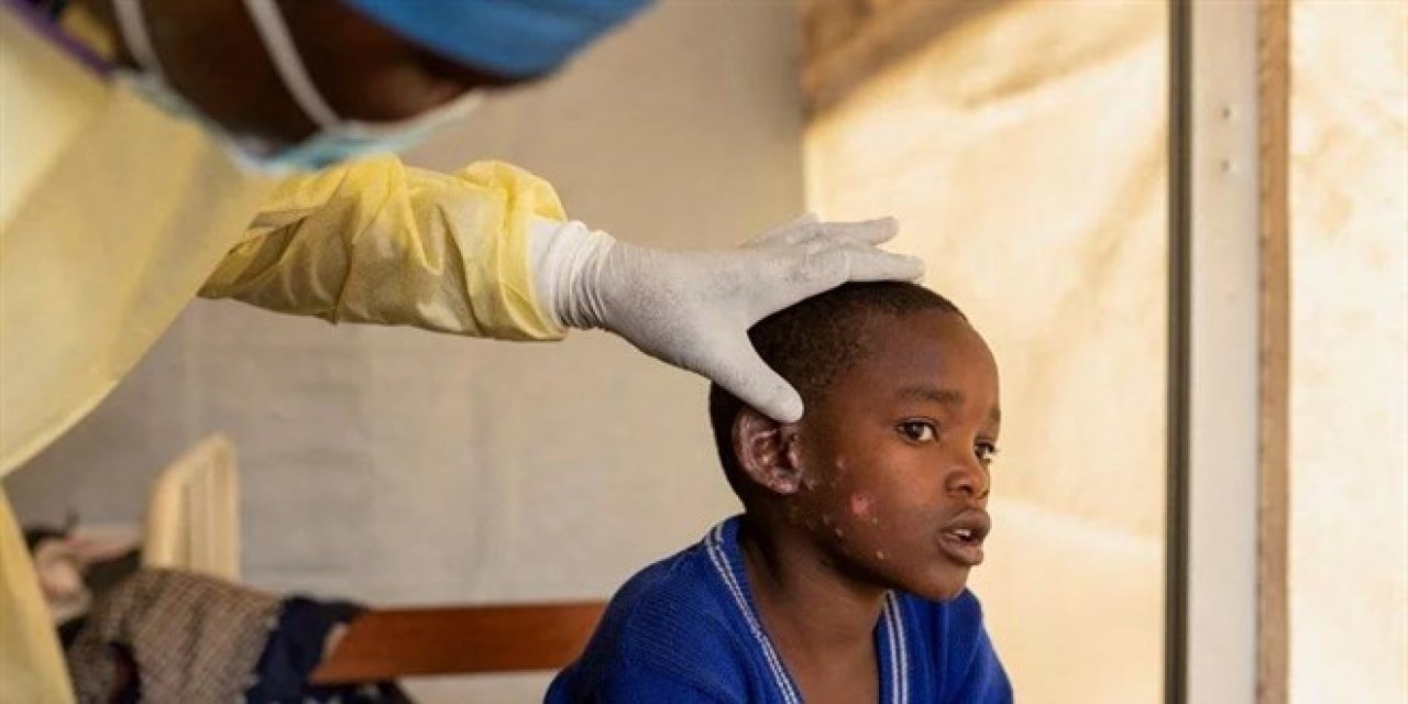 DSÖ'den maymun çiçeği çağrısı: Birlikte hareket etmeliyiz