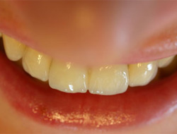 Diş ağrılarına kesin çözüm!