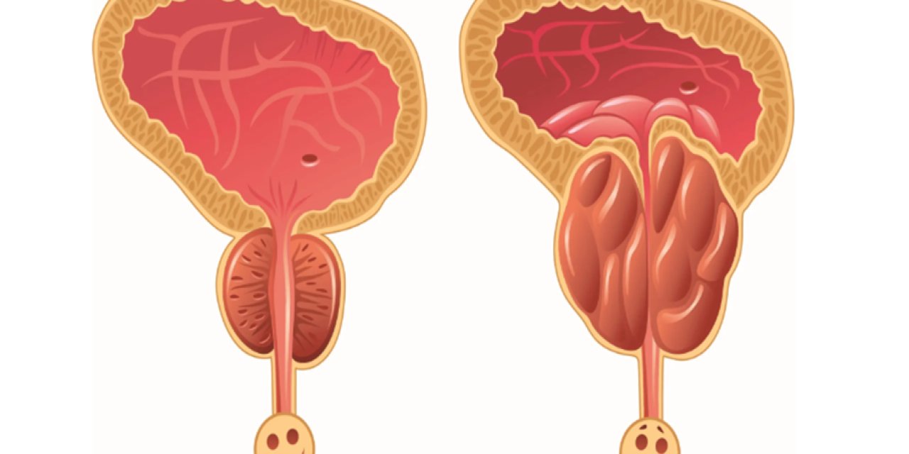 Kronik Prostatit Ankara: Ankara'da Uzman Ürologlar, Prostatit Tedavisi