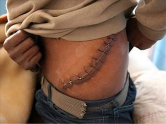 'Organ mafyası şehir efsanesi'