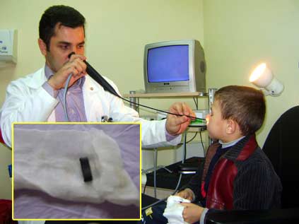 Oyuncak parçası 2 yıl burnunda kaldı