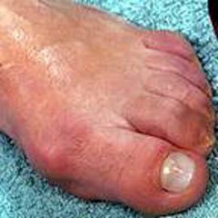 Mantar hastalığının önüne nasıl geçilir?