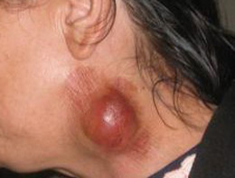 Bu hastalık için kırmızı alarm verildi