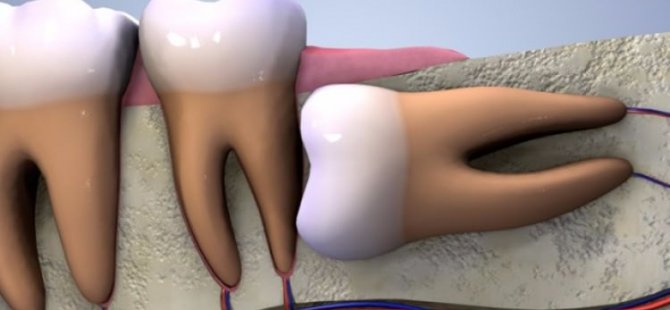 20'lik diş ağrısına ne iyi gelir?