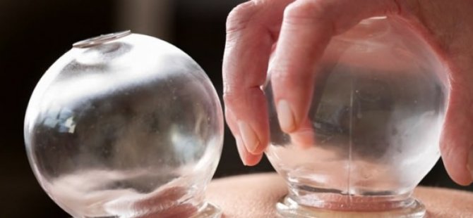 Tıpta 5 bin yıllık şifa hacamat