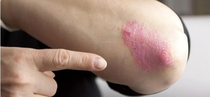 Stresli hastalık: Sedef