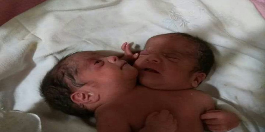Çift başlı bebek dünyaya geldi
