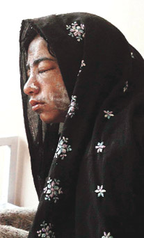 Liseli kızların yüzüne asit atıp kaçtılar