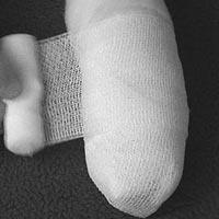 14 yıl kalbinde sargı beziyle yaşadı