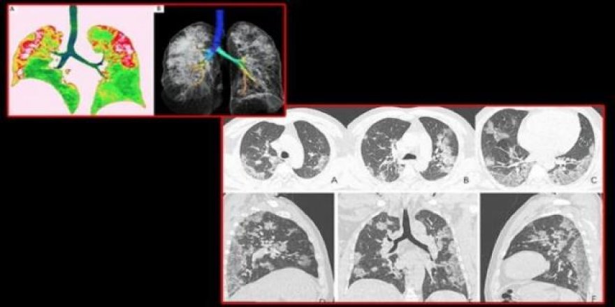 İlk kez yayınlandı! Koronavirüs bu hale getiriyor