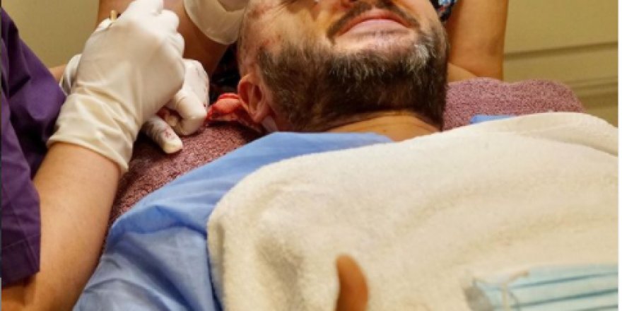 DHI saç ekimi, Tedavi sürecinde mevcut saçlarınızın görüntüsünü değiştirmiyor!