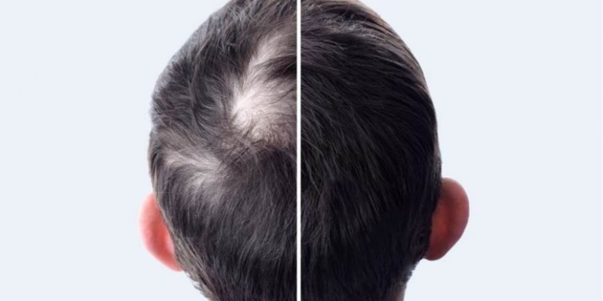 Artık Çok Sayıda Erkek Saç Ekimi Tedavisi Tercih Ediyor